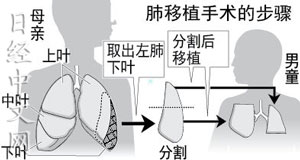 日本成功實施全球較精細活體肺移植手術（圖）