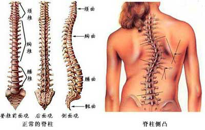 日本治療脊柱側(cè)彎