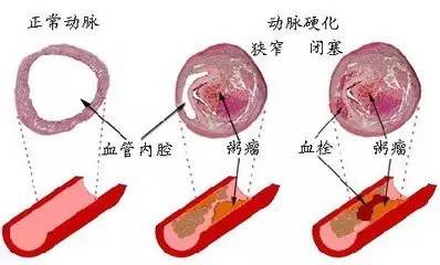 日本治療冠狀動脈粥樣硬化