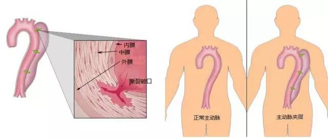 日本治療冠狀動脈粥樣硬化