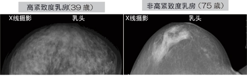 乳腺癌如何檢查？日本開發(fā)出一種新技能可用于早期檢測乳腺癌