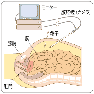 日本早期結直腸癌治療