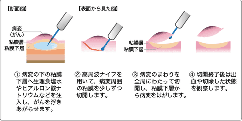 日本早期結直腸癌治療