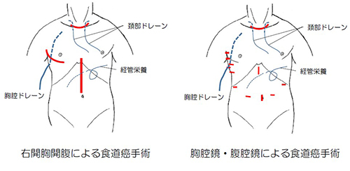 食管癌治療方法