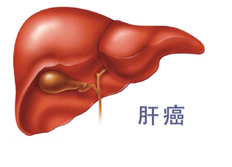 肝癌治療