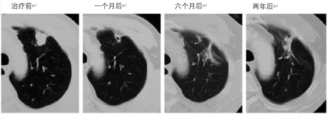 肺癌質(zhì)子治療