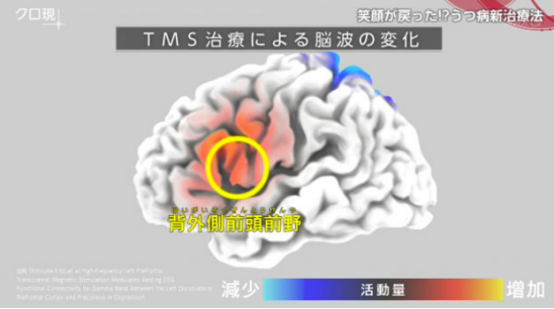 抑郁癥治療方法