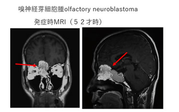 嗅神經(jīng)母細(xì)胞瘤