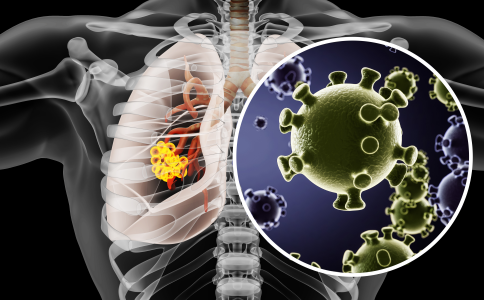 日本治療肺癌的方法