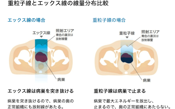 重離子放療優(yōu)勢