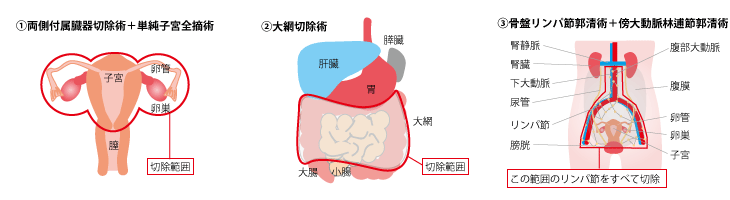 日本卵巢癌治療