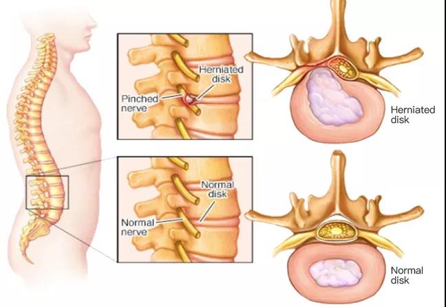 腰椎間盤突出治療