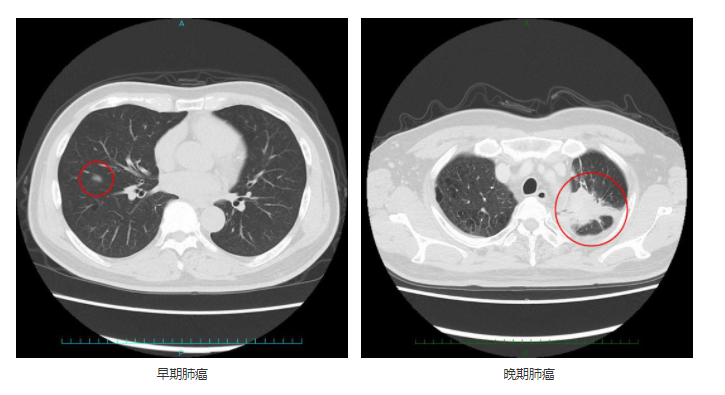 早期肺癌與晚期肺癌的CT影像