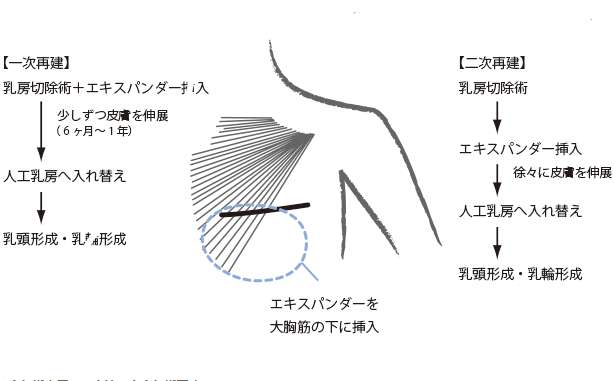 乳腺癌乳房重建術(shù)