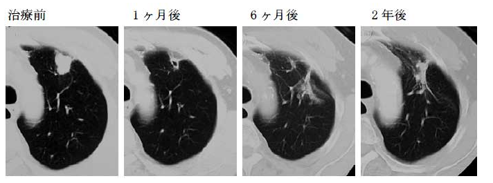 質(zhì)子重離子治療肺癌