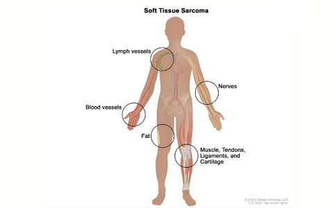 兒童軟組織肉瘤治療