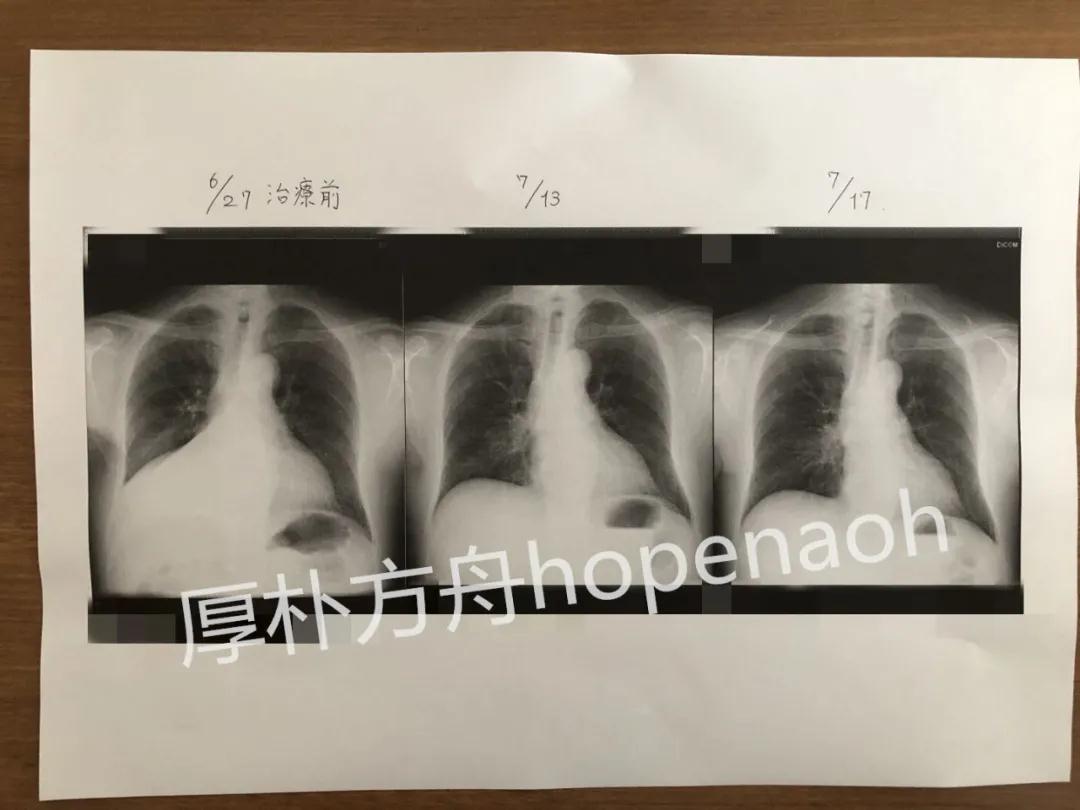 日本治療肺癌