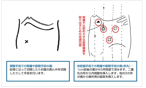 腎癌腹腔鏡手術