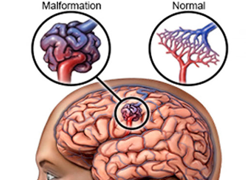 腦動(dòng)靜脈畸形