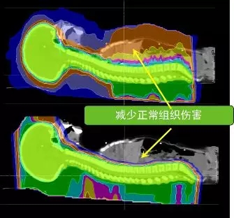 質(zhì)子治療