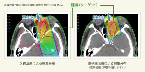 日本質(zhì)子治療兒童腫瘤醫(yī)院