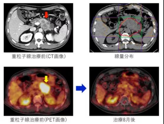 質(zhì)子重離子治療胰腺癌