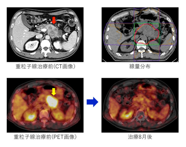 質(zhì)子重離子治療胰腺癌