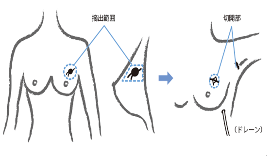 乳腺癌保乳手術