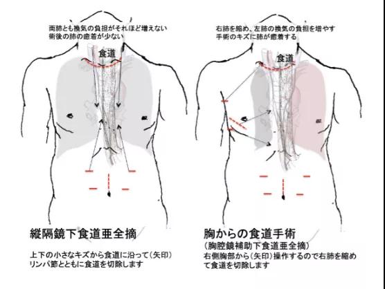 食管癌微創(chuàng)手術