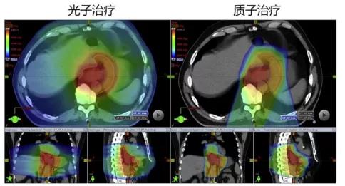 質子重離子治療食管癌