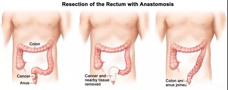直腸癌保肛手術