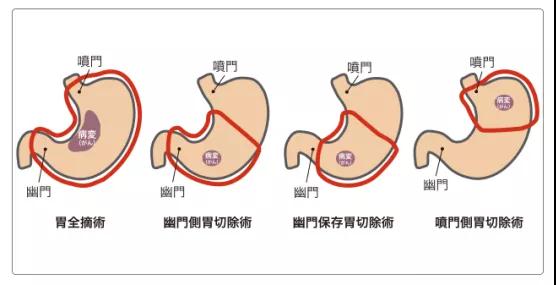 胃癌手術(shù)治療