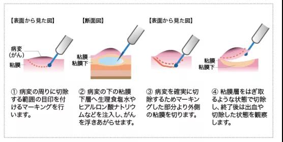 食管癌內(nèi)鏡治療