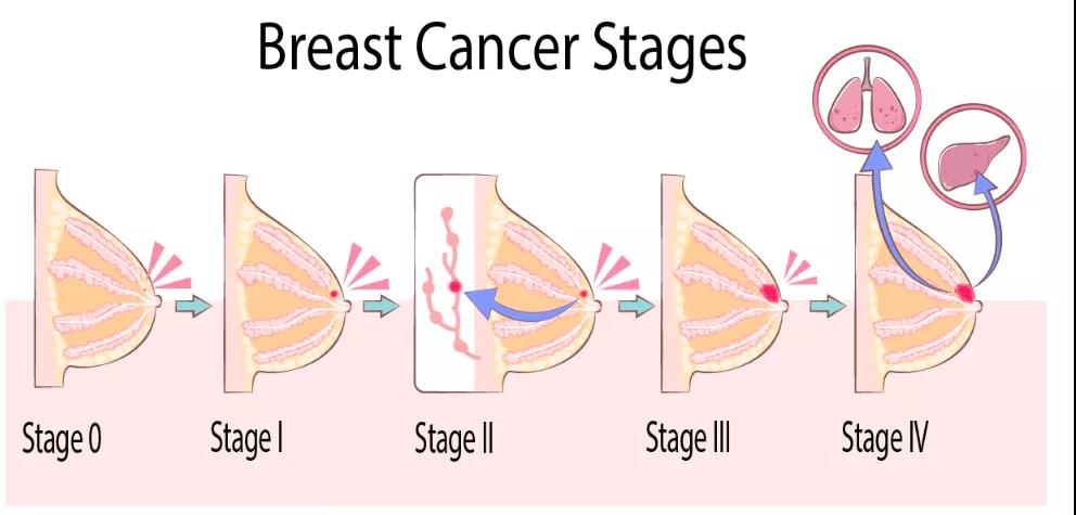 乳腺癌手術(shù)治療