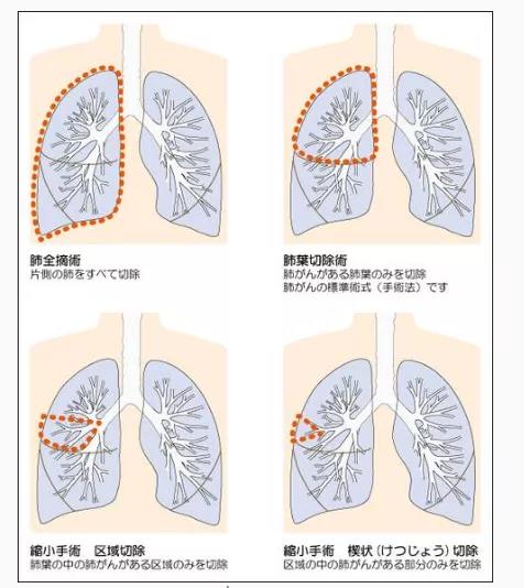 肺癌手術治療