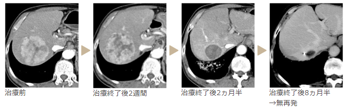 肝癌質(zhì)子治療