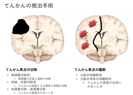 癲癇日本手術治療