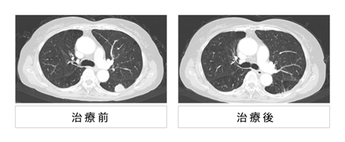 日本質(zhì)子重離子治療