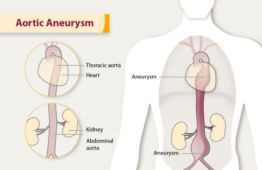主動脈瘤日本手術(shù)