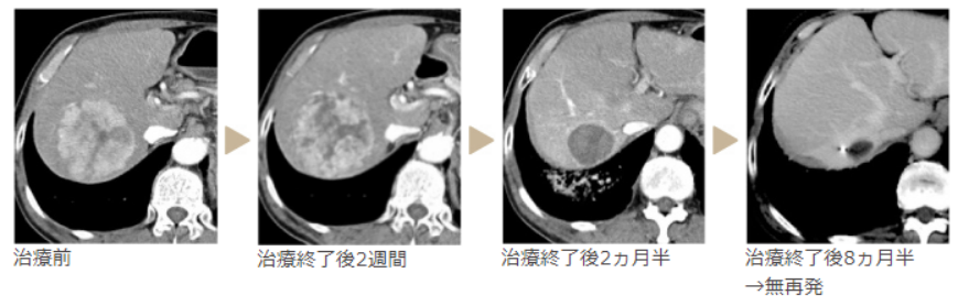 肝癌質子治療