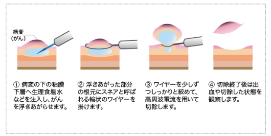 日本食道癌治療