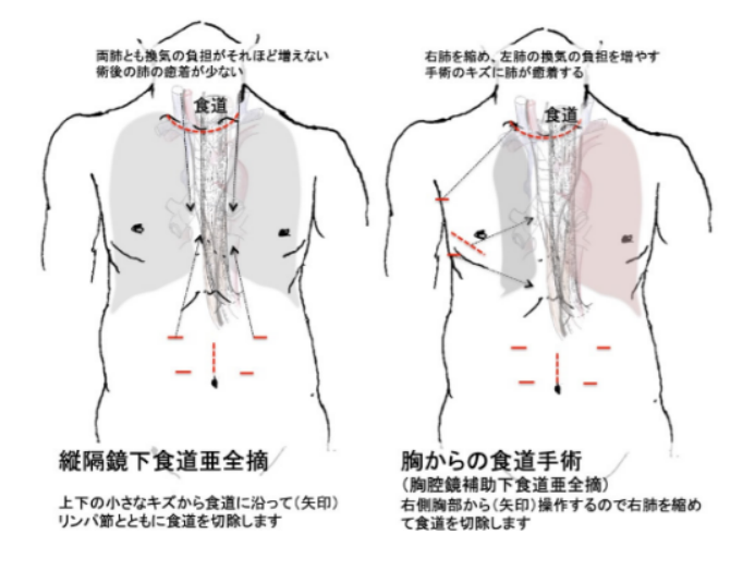 食道癌手術方式效果