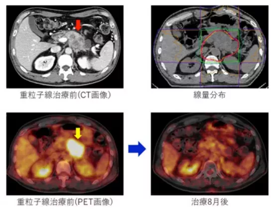 胰腺癌日本治療