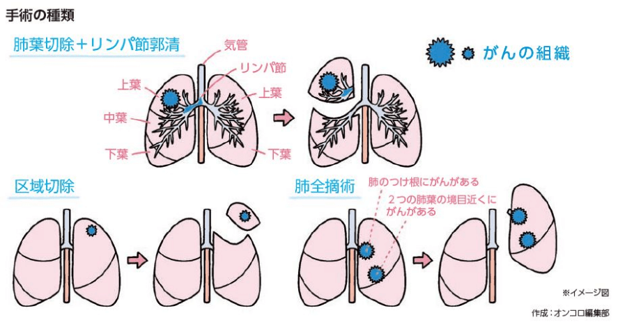 小細胞肺がんの治療－手術療法